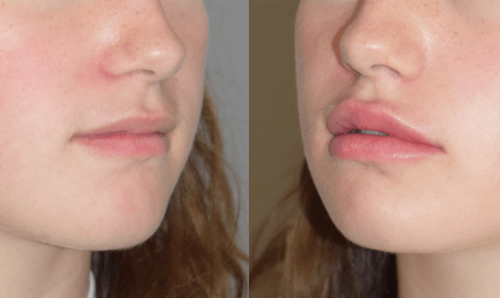 Top Lip Fullness Filler Before After Oakville Lip Doctor